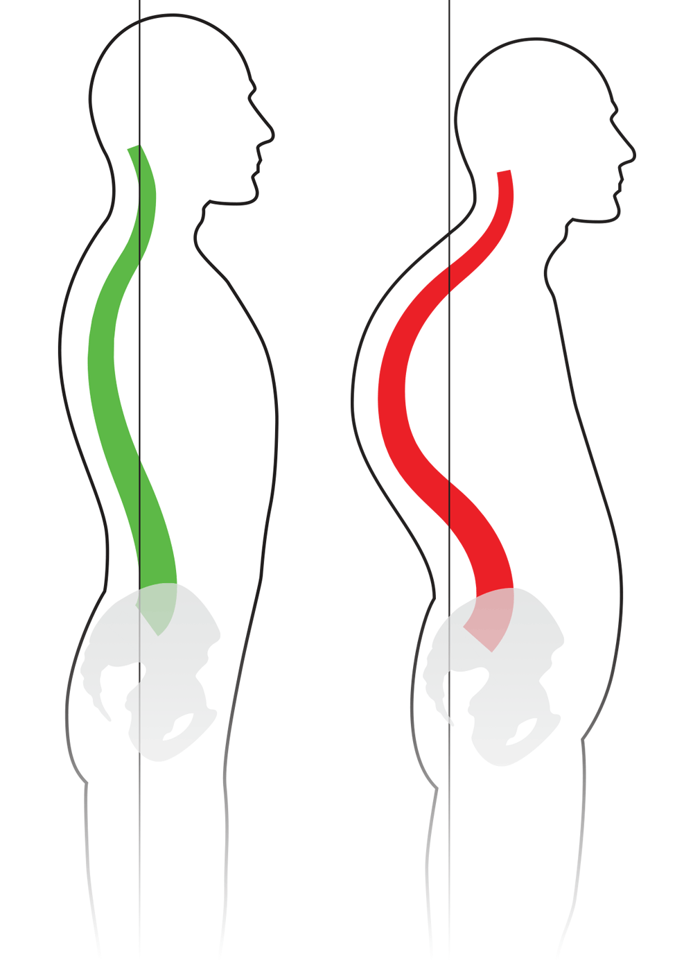 spinal-column-kyphosis-thoracic-kyphosis-spinal-deformity